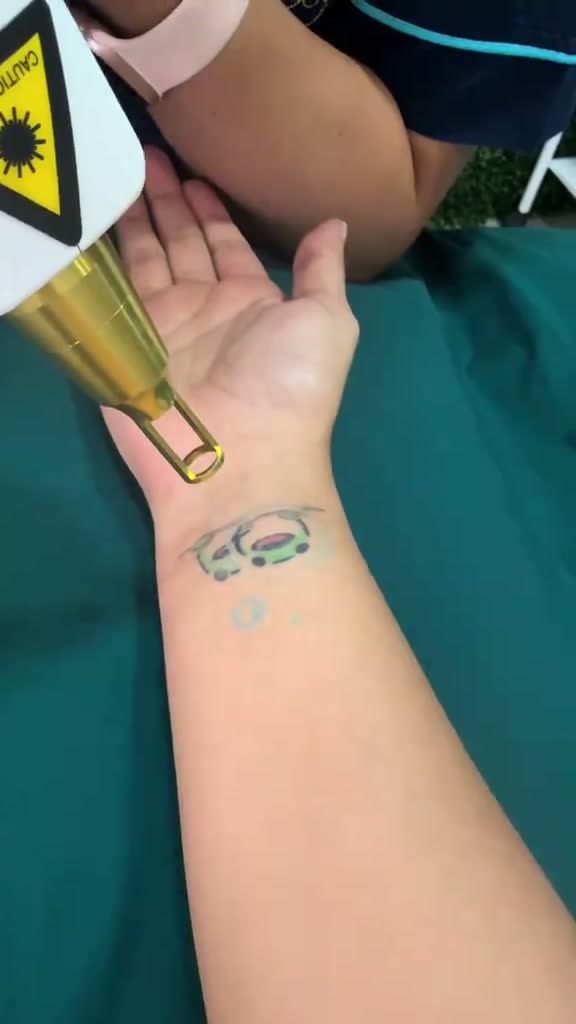 Tatuaje de ranita en la muñeca durante la sesión de láser